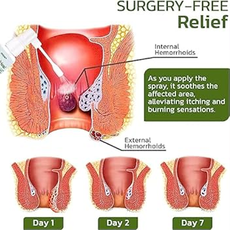 Herbal Hemorrhoids Spray (MG)