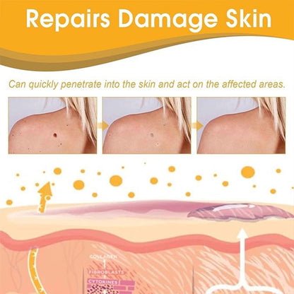 Warts Removal Cream