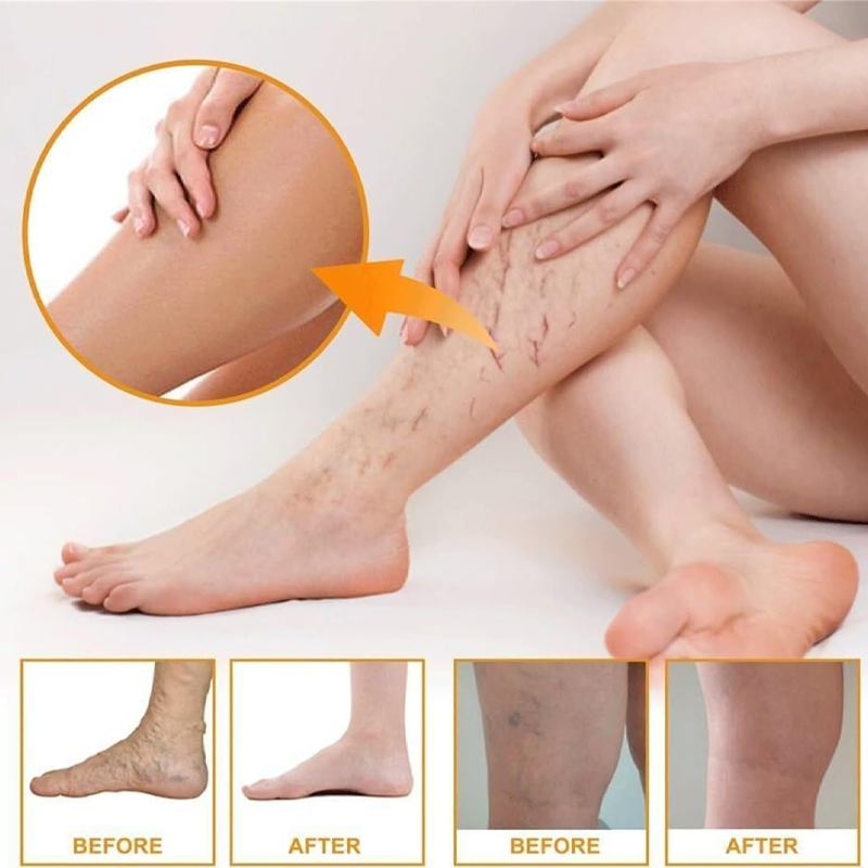 Varicose Veins Health Care Paste