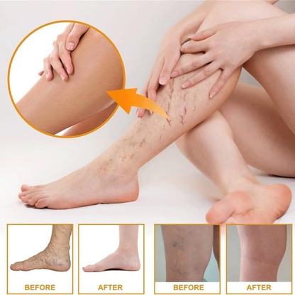Varicose Veins Health Care Paste