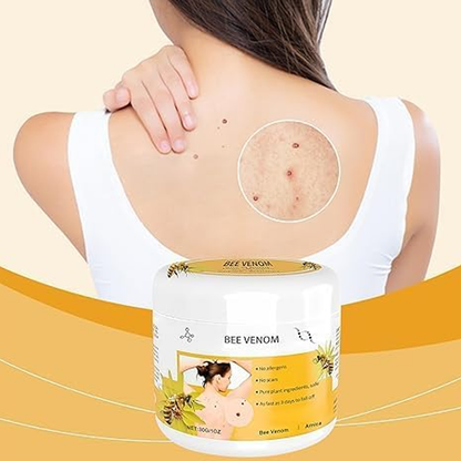 Warts Removal Cream fast results