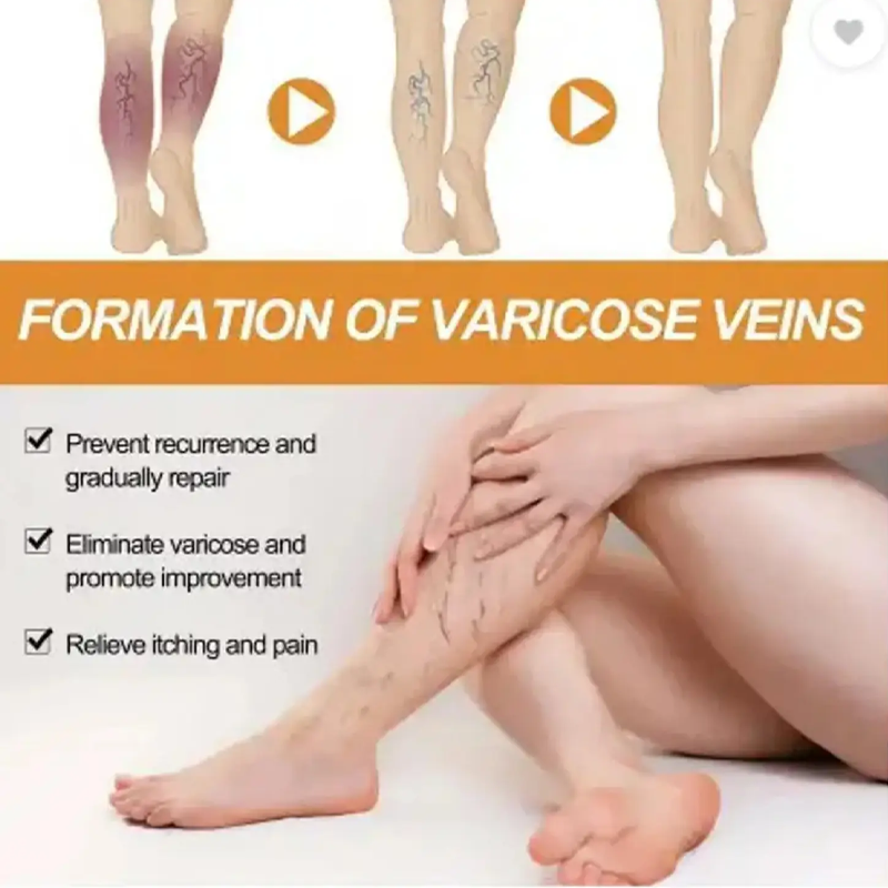 Varicose Veins Health Care Paste