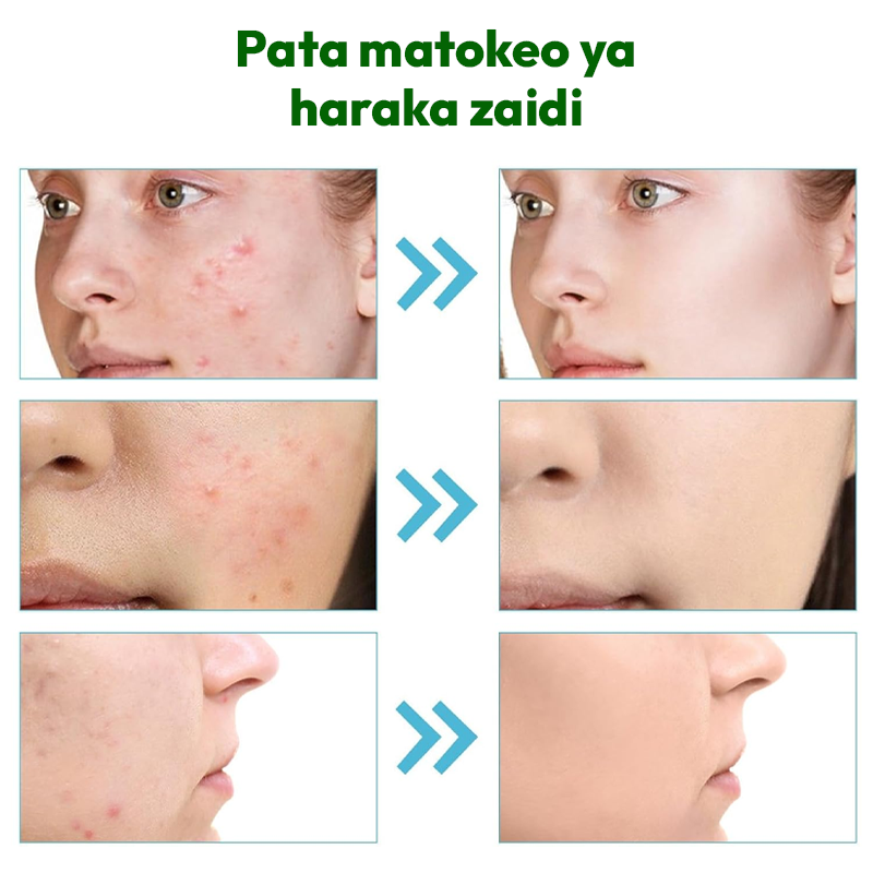 Acne Gel 100% Natural