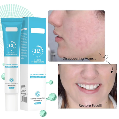Acne Gel