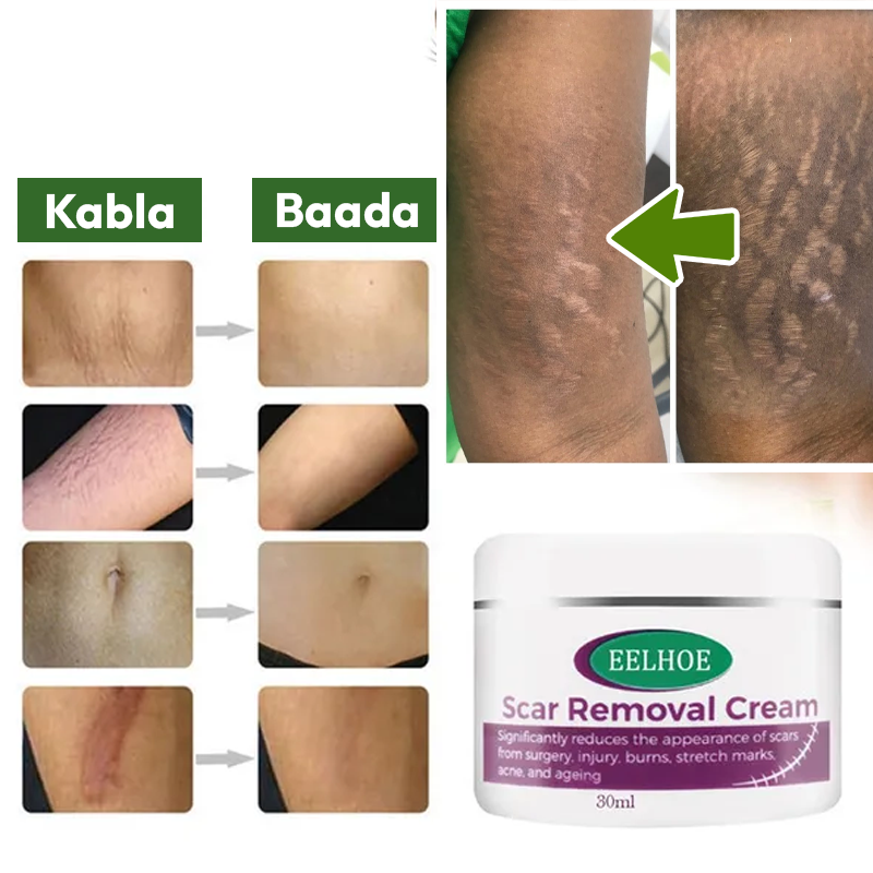 Scar Removal Cream nw