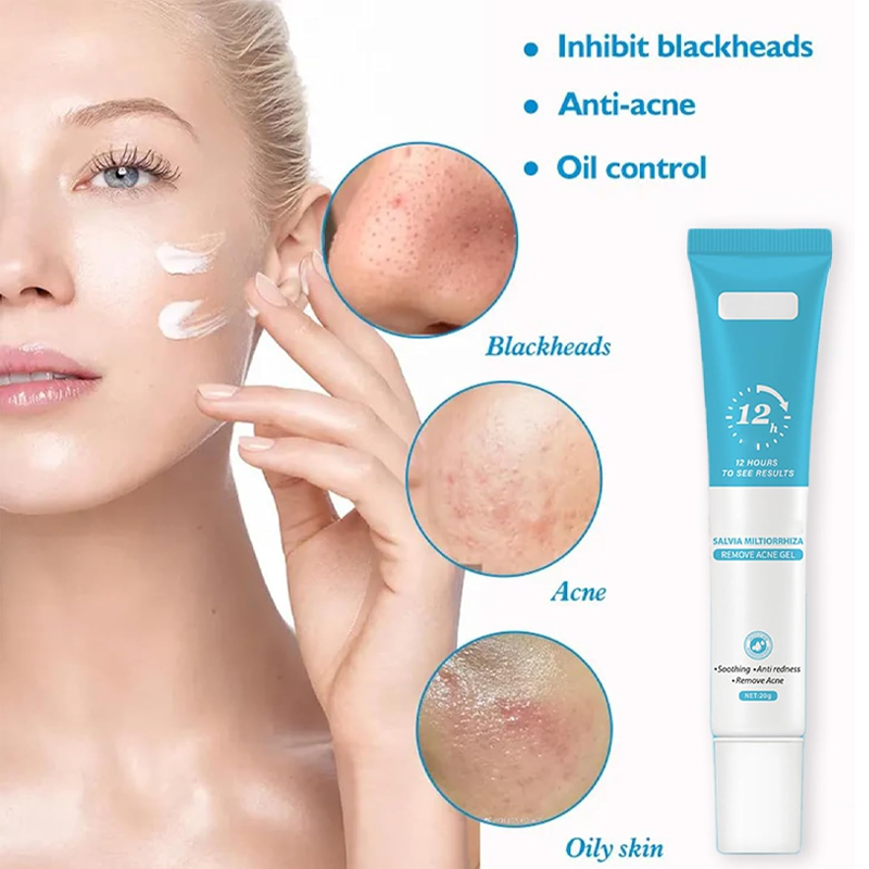 Acne Gel