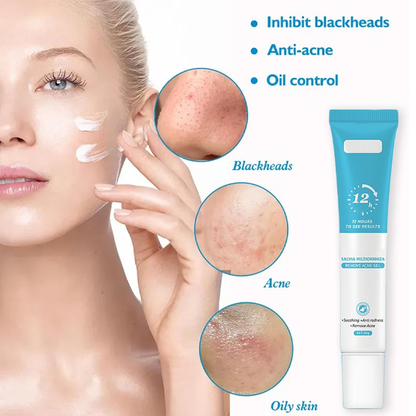 Acne Gel