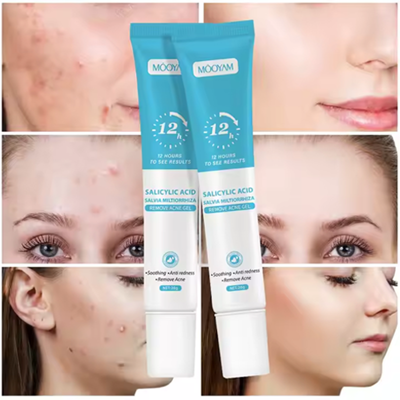 Acne Gel 100% Natural