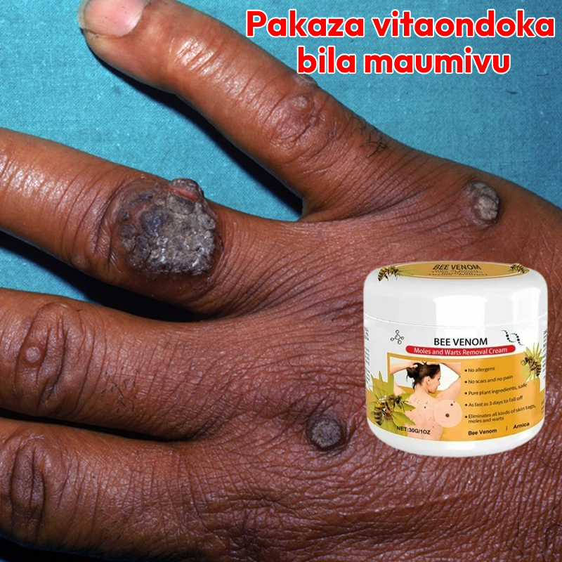 Warts Removal Cream 100% Natural L-84