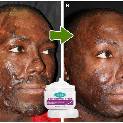 Scar Removal Cream nw