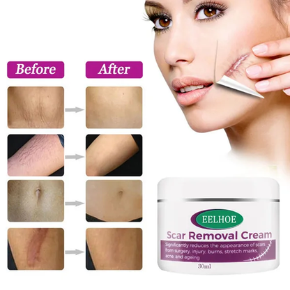 Scar Removal Cream