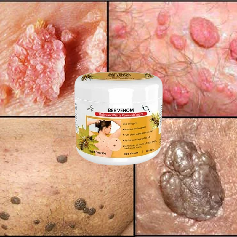 Warts Removal Cream care 100%