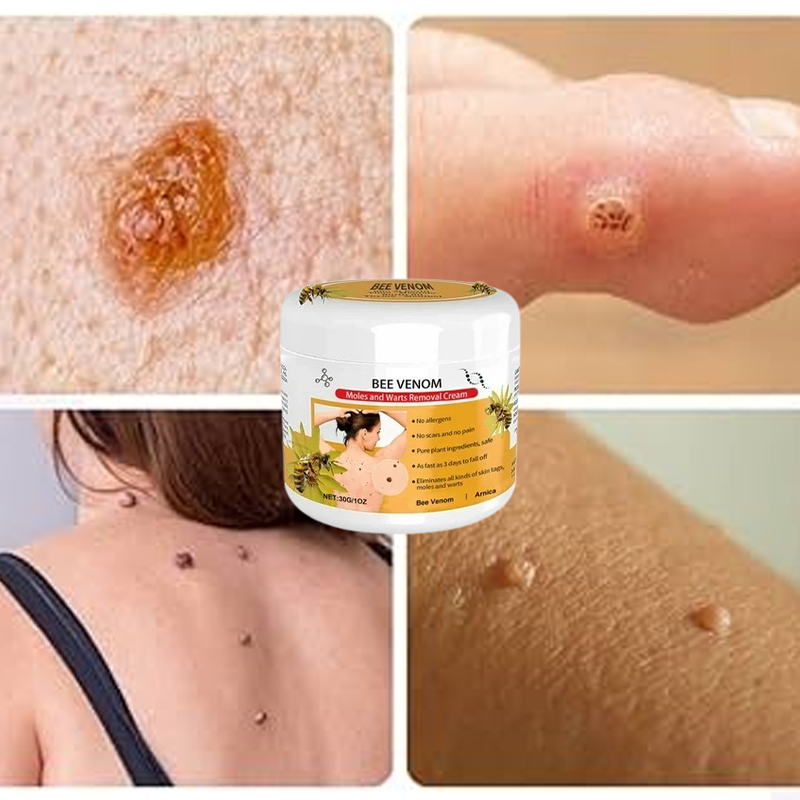 Warts Removal Cream 100% Natural