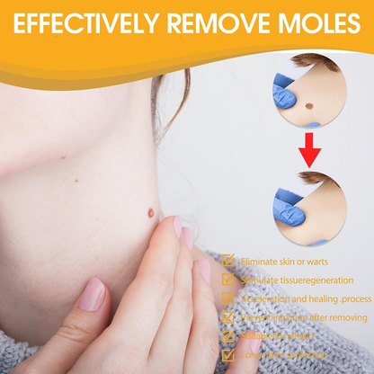 Warts Removal Cream fast results