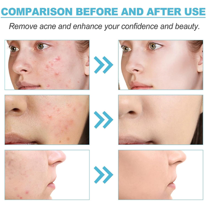 Acne Gel