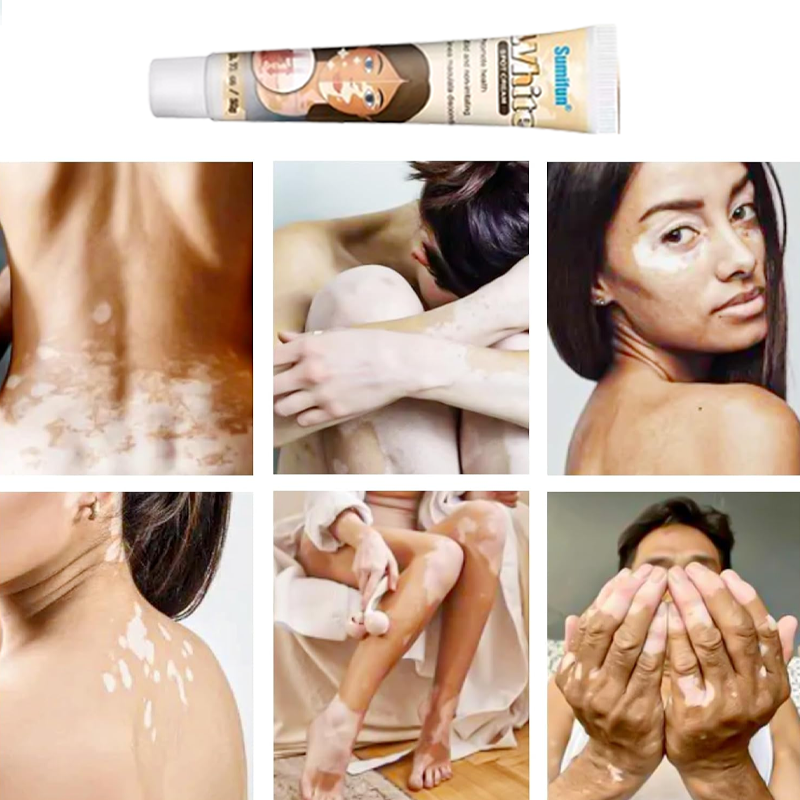 White Spot Cream