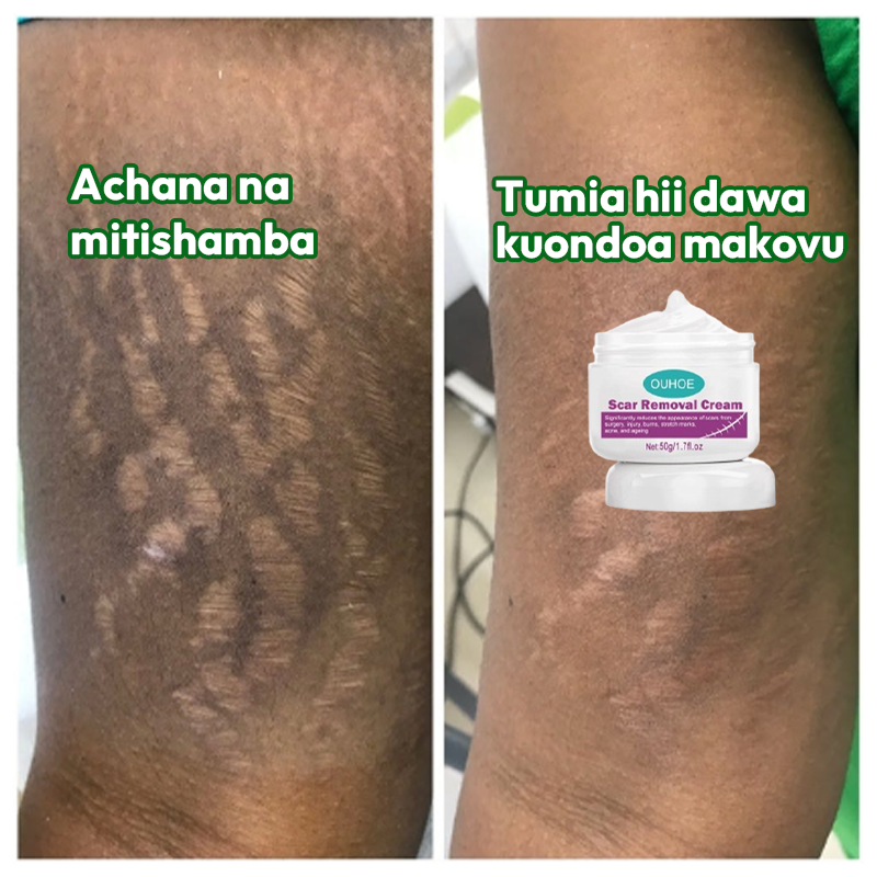 Scar Removal Cream 100% Natural guarantee